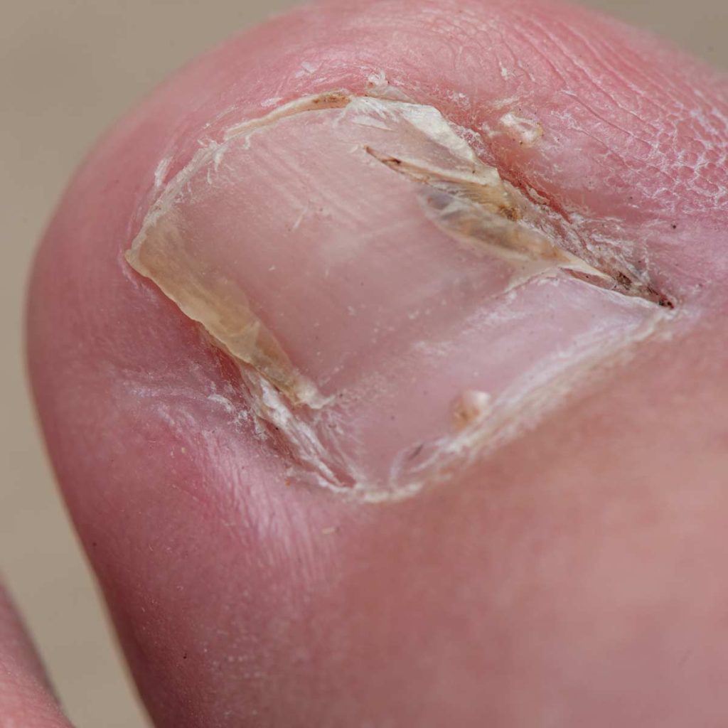 Broken Toenail Treatment Options Explained - Thomas Podiatry & Associates