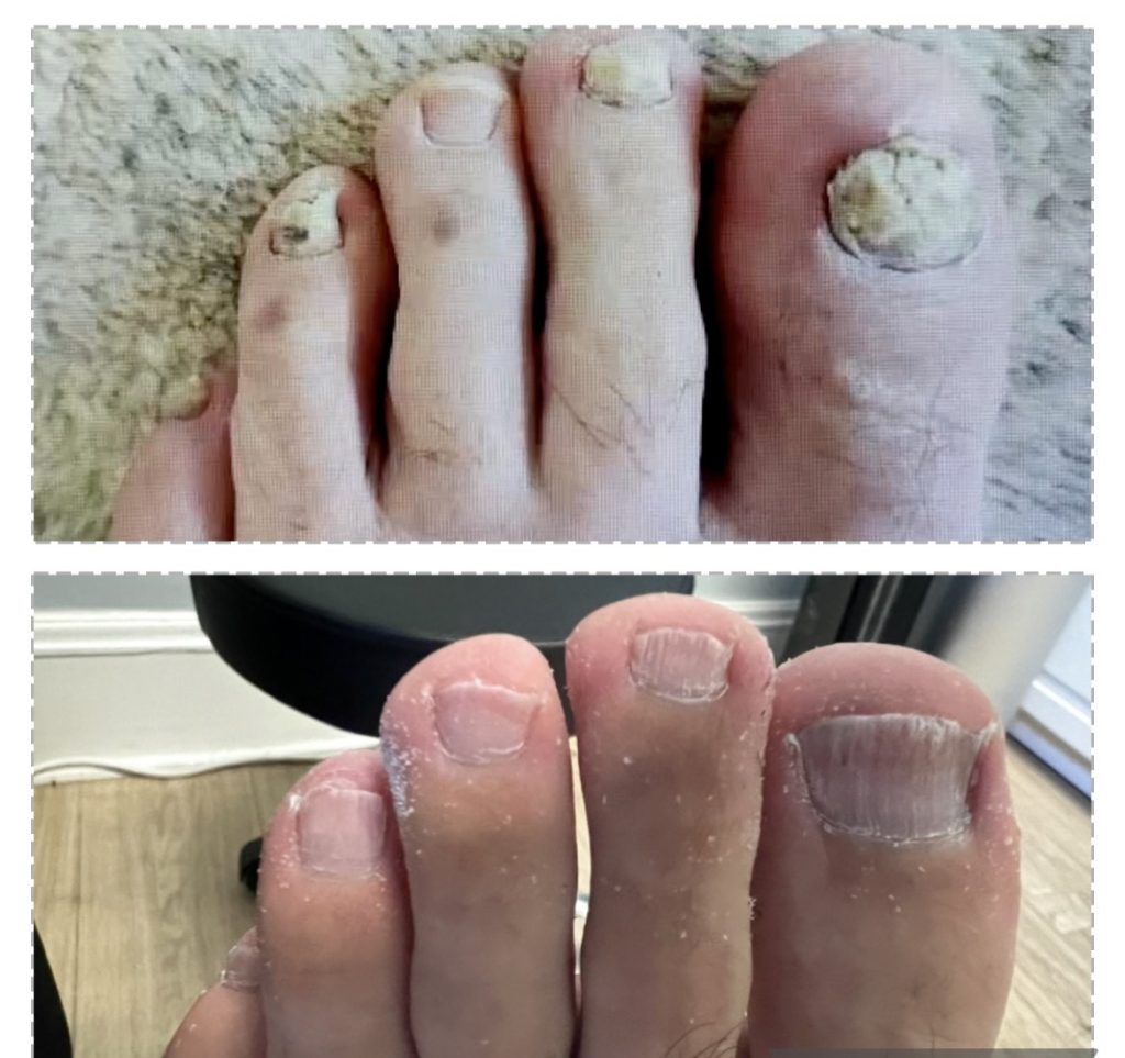 Vicks or Vinegar for fungal foot infection?